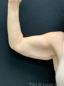 Brachioplasty-before