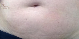 4 tretments for strech mark at Yuva-after