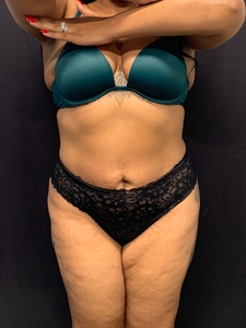 LAL-lower abdomen + mini tummy tuck-before