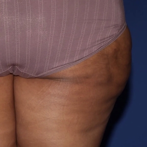 Cellulite Reduction #2-after