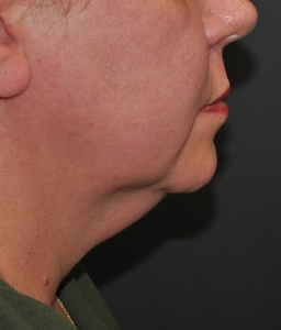 FaceTite & Liposuction 12 Days-before