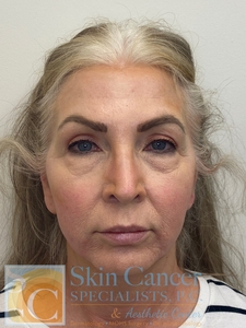 Nova Threads and Cheek Filler-after