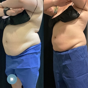 Coolsculpting-before