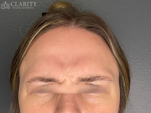 Daxxify: Frontalis-before