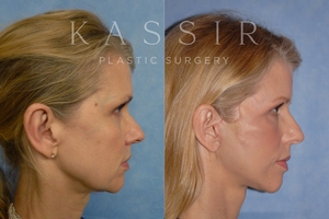 Designer Face Lift Before and After-after