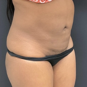 Liposuction #5-after