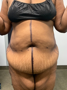 Tummy Tuck-after