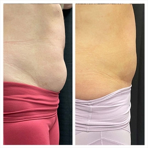 CoolSculpting - Cycles-before