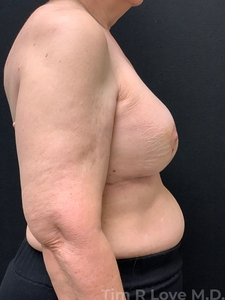 Implant Exchange-after