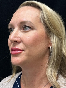 1 syringe Restylane Kysse in lips-after