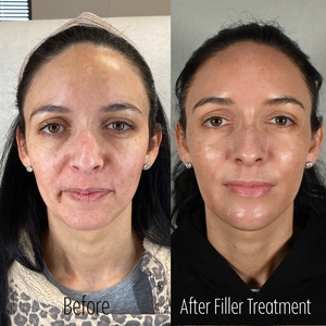 Filler B/A TW-before
