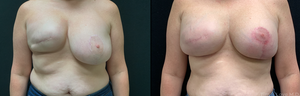 1 month post op 2 stage breast reconstruction with shaped implant, revision mastopexy, and fat graft-before