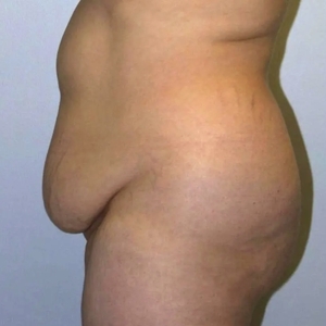 Mommy Makeover #8-before