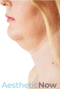 Kybella #2-before