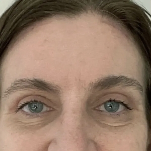 Brow & Eye Lift #1-after