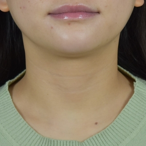Neck Lines-after