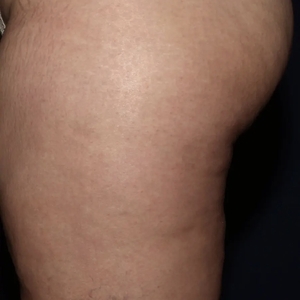 Cellulite Reduction #3-after