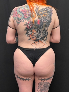 LAL-BBR + waist + BBL-before