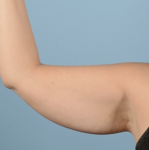 Lipo w BodyTite #7-before