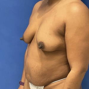 Mommy Makeover #2-before