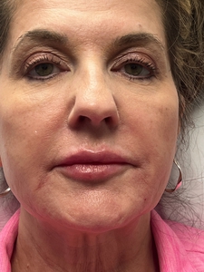 1/2 syringe of lip filler for upper lip-after