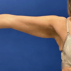 Lipo w Renuvion #11-before