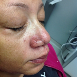 2 Profractional treatments for scar on nose-after