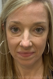 forehead Before and after jeuveau-after