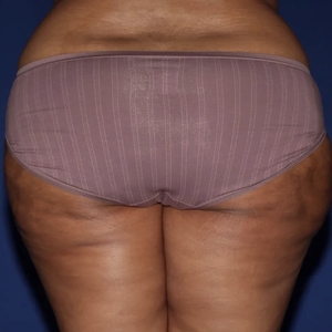 Cellulite Reduction #2-after