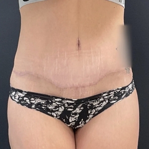 Mommy Makeover #13-after