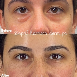 Filler B/A SBA 30-before