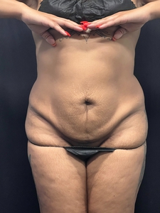 LAL-lower abdomen + mini tummy tuck-after