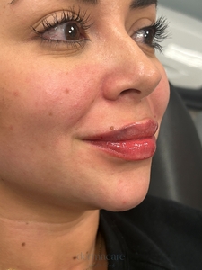 Whitney Devall RN. - Versa-after