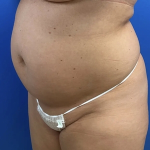 Lipo w Renuvion #3-before