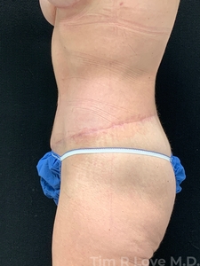 5'2, 120lb, 50 year old post-bariatric surgery patient. She is 3 months post op circumferential body lift with gluteal fat grafting and mastopexy with 345cc shaped highly cohesive implants.-after