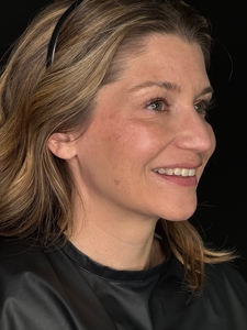 Ashley R. RN. Treated with Botox-after