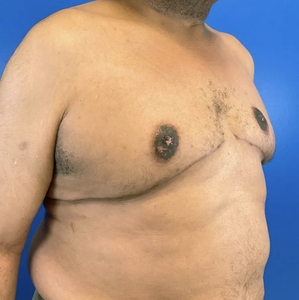 Male Breast Reduction #2-after