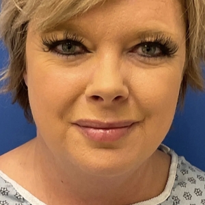 Lipo w Skin Tightening Face #2-before