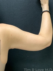 Brachioplasty-after