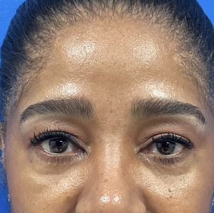 Brow & Eye Lift #3-after