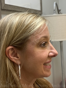 Jeuveau crows feet-after