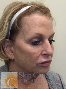 Nova Threads and Cheek Filler-after