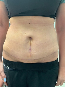 Skin tyte skin tightening for abdomen-after