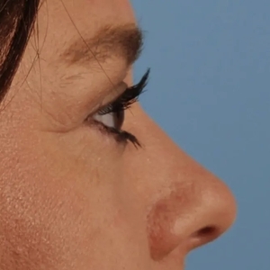 Brow & Eye Lift #5-after