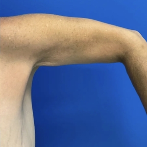 Lipo w Renuvion #4-after