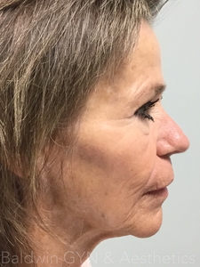 LOWER FACE PLUS MIDFACE FILLER-after