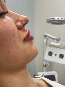 Danielle Glass RN. - Versa-after