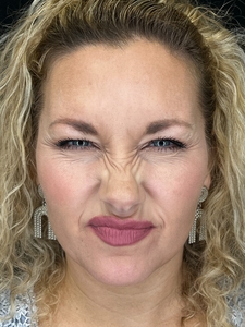 Neuromodulators-before