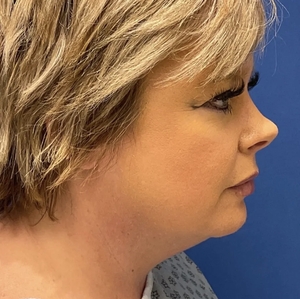 Lipo w Skin Tightening Face #2-before