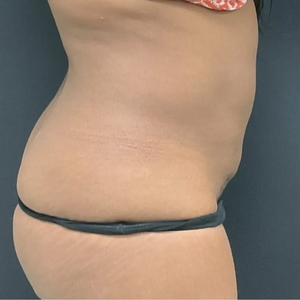 Liposuction #5-after